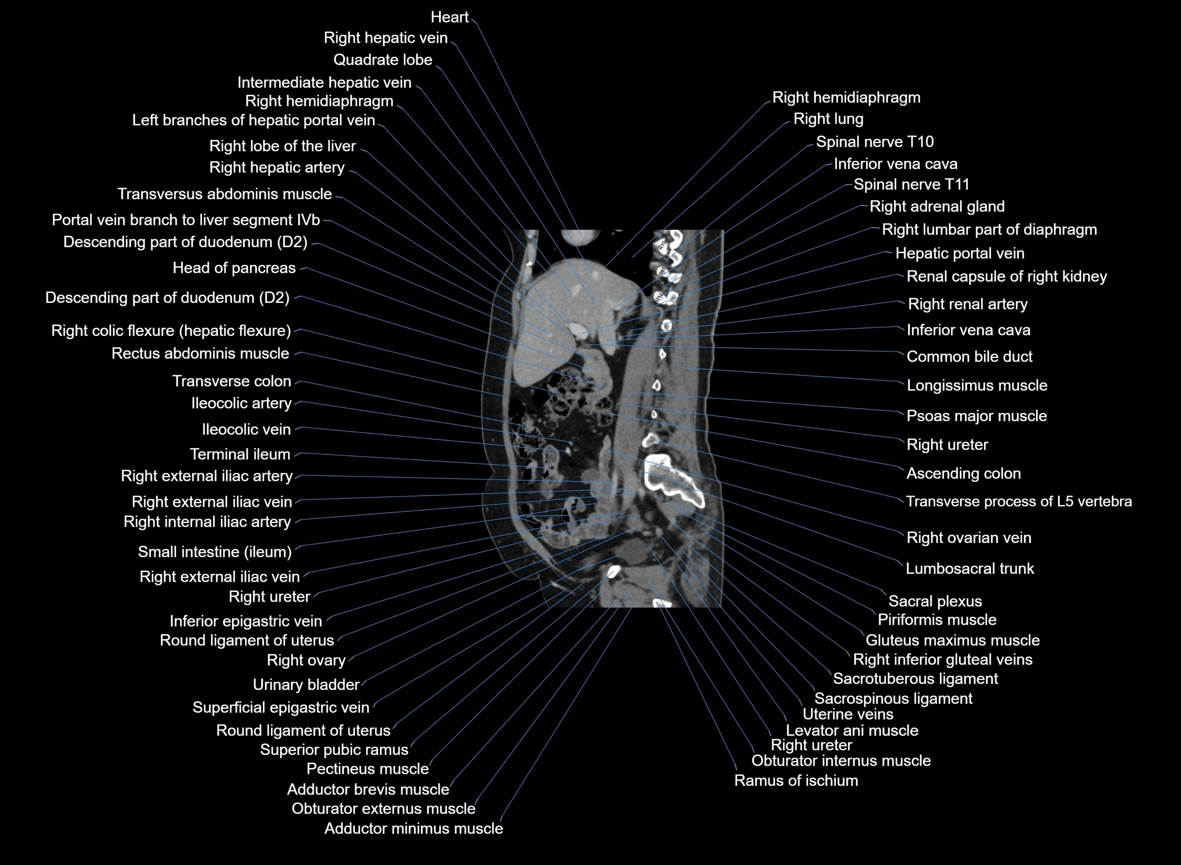 CT Abdomen sagittal cross sectional anatomy labelled radiology image -00071.webp